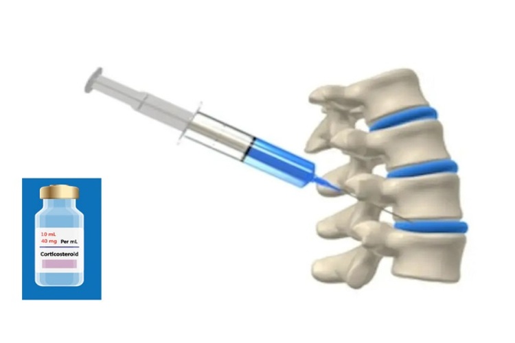 Trường hợp đau lưng nặng do đứng lâu, người bệnh có thể được chỉ định tiêm corticosteroid